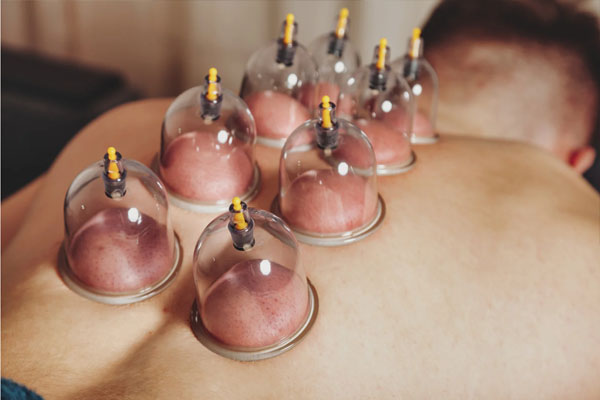 Cupping Therapy | ಕಪ್ಪಿಂಗ್ ಥೆರಪಿ ಅಂದ್ರೇನು? ಯಾರಿಗೆ ಈ ಚಿಕಿತ್ಸೆ ಸೂಕ್ತ?