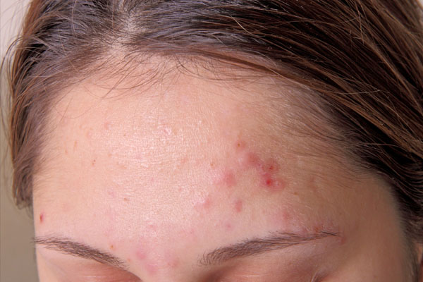 Hair Care & Skin | ತಲೆಯಲ್ಲಿ ಡ್ಯಾಂಡ್ರಫ್ ಇರೋದಕ್ಕೂ ಮುಖದಲ್ಲಿ ಮೊಡವೆ ಬರೋದಕ್ಕೂ ಏನ್ ಸಂಬಂಧ ಇದೆ?