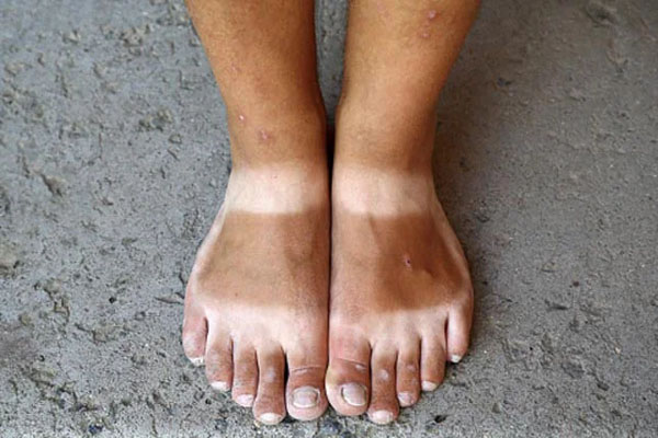 Skin Care| ಬಿಸಿಲಿನಿಂದ ನಿಮ್ಮ ಪಾದಗಳು ಕಪ್ಪಗಾಗಿವೆಯೇ? ಈ ರೀತಿ ಮಾಡಿದ್ರೆ ಟ್ಯಾನ್ ಎಲ್ಲ ಮಾಯಾ ಆಗುತ್ತೆ ನೋಡಿ