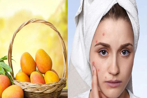Skin Health | ಮಾವಿನ ಹಣ್ಣು ತಿನ್ನೋದಕ್ಕೂ ಮುಖದಲ್ಲಿ ಪಿಂಪಲ್‌ ಬರೋದಕ್ಕೂ ಲಿಂಕ್ ಇದ್ಯಾ?